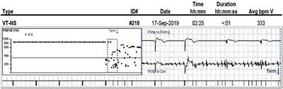 One day, in a town not too far from here, the icu registrar (you) is admitting a 60 year old male, who has just been brought into. Permanent His Bundle Pacing A Programming And Troubleshooting Guide Sciencedirect