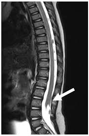 Image result for Spinal Dysraphism