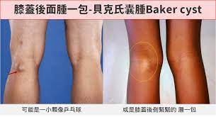 膝關節積水膝蓋腫脹的原因及如何治療處理» 台北原力復健科診所-侯鐘堡醫師