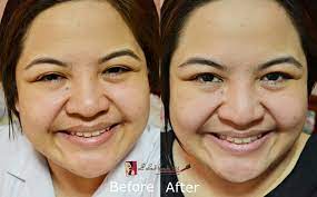 The body uses a lot of vitamin c to make connective tissue and high levels of the vitamin speed the healing of surgical wounds. Opulence Skin Nutrawhite L Glutathione With Boosters All About Beauty 101