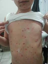Smallpox )‏ هو مرض معدي ذو أصل فيروسي وشديد العدوى وبائيًا بسبب فيروس الجُدَرِيُّ الكبير (وهو الأكثر شيوعًا والأكثر شدة) والجدري الصغير وهو الأقل شدة وانتشارًا، وتشمل الأعراض الأولية للمرض الحمى والقيء. Ø¬Ø¯Ø±ÙŠ Ø§Ù„Ù…Ø§Ø¡ Ù…Ø±Ø¶ ÙÙŠØ±ÙˆØ³ÙŠ Ø¹ÙŠØ§Ø¯Ø© Ø·Ø¨ Ø§Ù„Ø§Ø·ÙØ§Ù„ Ø¯ Ø§Ø³Ø§Ù…Ø© Ø§Ù„Ø²Ø¹Ø¨ÙŠ Facebook