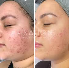 High Frequency Facial at Fixation Skincare in Sheffield
