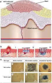 This is due to an increased turnover of skin cells. Advances In Antimicrobial Microneedle Patches For Combating Infections Jamaledin 2020 Advanced Materials Wiley Online Library