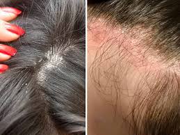 Side effects of chemotherapy or radiation therapy Why Is My Scalp So Itchy How To Treat It Laylahair