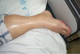 Image result for Edema