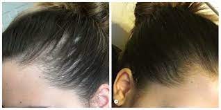 A dermatologist can also provide hair loss treatment options to individuals who do not want to wait 6 to 9 months for their hair to grow back. Does Hair Grow Back If You Have Alopecia