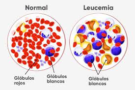 Check spelling or type a new query. Leucemia Tipos Causas Y Tratamiento Tua Saude