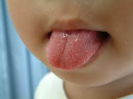 きのした小児科 溶連菌感染症