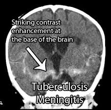 Virtualmedstudent Com Tuberculosis Meningitis Radiology Meningitis Radiology Imaging
