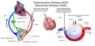 Image result for Decompression Sickness