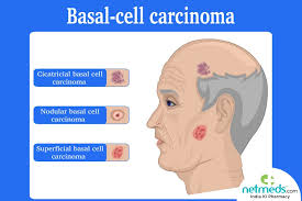 Basal cell carcinoma is the most common skin cancer in the united states, with nearly 3 million cases diagnosed each year. Basal Cell Carcinoma Causes Symptoms And Treatment Netmeds