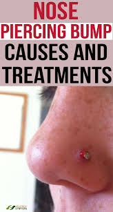 Nose Piercing Bump Causes And Treatments Nose Piercing Bump Nose Piercing Nose Piercing Tips