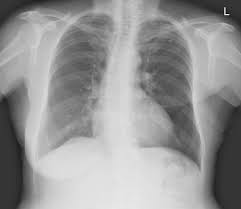 Each cancer type would look different on an mri, ct scan or pet scan. Ivory Vertrebra From Breast Cancer Metastasis Radiology Case Radiopaedia Org