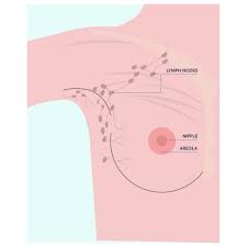 It is most common in women but also affects a small number of men each year. How Does Breast Cancer Start Spread Nbcf