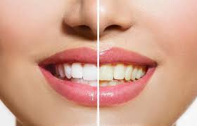 Fresas para blanquear tus dientes. Como Blanquear Tus Dientes Desde La Comodidad De Tu Casa