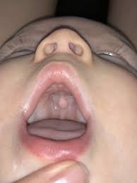 Your abscess on the roof of your mouth or palatal abscess typically represents the directed drainage coming from an infection of your tooth nerve or how much ciggretes can cause mouth cancer? Hard Bump On Roof Of Mouth Babycenter