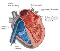 La fibrillation auriculaire désigne un trouble du rythme cardiaque dans lequel les oreillettes battent irrégulièrement et de manière non coordonnée avec les traitements possibles sont: Ablation De Fibrillation Atriale Lyon Ccjj Centre Cardiovasculaire Jean Jaures