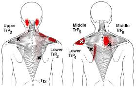 Pin On Back Neck Saga Living With Chronic Pain