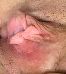 Read on for more information. Painful Bump On Vulva Papersculpture Eu