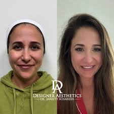 Lipo Shots & Fat Melting