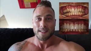 Gold Coast Dental Veneers Review from Zac Smith!