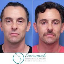 Tim Minton, MD, FACS