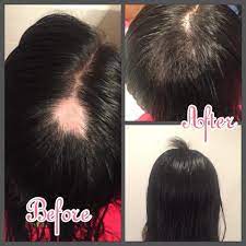 Somewhere between three to six months after giving birth, a new mom will often experience a sudden shedding of hair. My Friend Suffered From Post Partum Alopecia She Did A Very Good Job In Hiding Her Bald Spot Cause I Didn T Ev Healthy Hair Hair Loss Remedies Kids Hairstyles