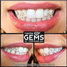 Tooth Gems By Toothgems Happening At The Shop Tonight 4pm 9pm I Know Some Of You Have Been Waiting For This Now Is The Time Tooth Gem Diamond Teeth Teeth