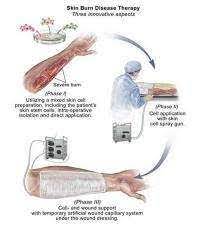 Skin Cell Spray Gun Drastically Cuts Healing Time For Burns