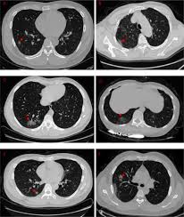 It was first identified in december 2019 in wuhan,. Ct Imaging And Clinical Course Of Asymptomatic Cases With Covid 19 Pneumonia At Admission In Wuhan China Journal Of Infection