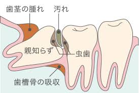 腫れづらい親知らずの抜歯｜高谷秀雄歯科クリニック｜宇都宮市中岡本町