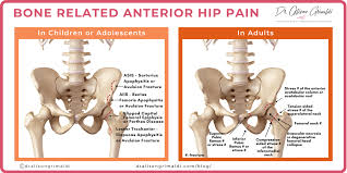 Image result for Hip Apophysitis