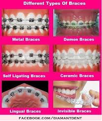Pin On Braces Orthodontics