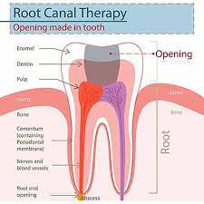 Gresham Root Canals Main Street Dental Gresham