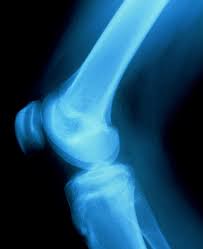 Image result for Knee XRay