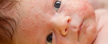 Grundlagen für eine erfolgreiche behandlung von pickeln mit hausmitteln. Milien Bei Babys Milia Neonatorum Hautunreinheit