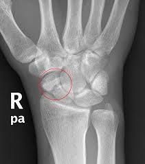 Image result for Scaphoid Bone