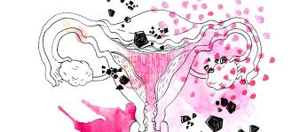 Une intervention chirurgicale est parfois nécessaire. Des Barbeles Dans Le Ventre L Endometriose Un Cancer Qui Ne Tue Pas