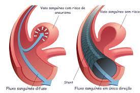 Um aneurisma pode ocorrer em qualquer artéria do corpo humano, quando acontece nas artérias que nutrem o cérebro, chamamos de aneurisma cerebral. Aneurisma Cerebral O Que E Sintomas Causas E Tratamento Tua Saude