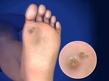 Download foot warts images and photos. Plantar Warts Lakeshore Bone Joint Institute Chesterton In