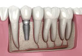 In order to give an indication of the gap that could exist between demand and supply, the half growth model in per capita demand and the medium scenario in supply are compared. Dental Implant Wikipedia
