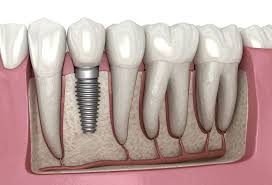 I had gap management contact my clients to get their opinions. Dental Implant Wikipedia
