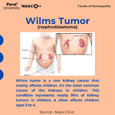 Image result for Nephroblastoma