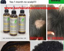 Rogaine is a regrowth treatment that helps you grow thicker, fuller hair. Hair Growth Bundle Hair Growth Products Hair Loss Treatment Etsy In 2021 Hair Growth Oil Hair Growth Cream Hair Growth Treatment