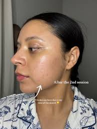 I can finally walk out with no makeup on. My skin has come such a long...