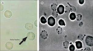 Image result for G6PD Deficiency Detection