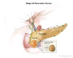 Pancreatic cancer (ductal adenocarcinoma of the pancreas) in the early stages typically causes vague nonspecific symptoms. Pancreatic Cancer Treatment Adult Pdq Patient Version National Cancer Institute