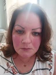 Thank you for adding me! I have never felt so hepless....I've been  diagnosed with SLE, celiac disease, and a diabetic. I have been