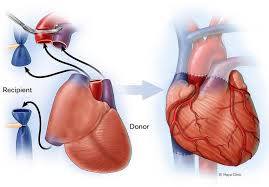 Image result for Transplantation