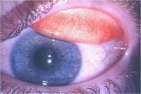 Image result for Allergic Conjunctivitis
